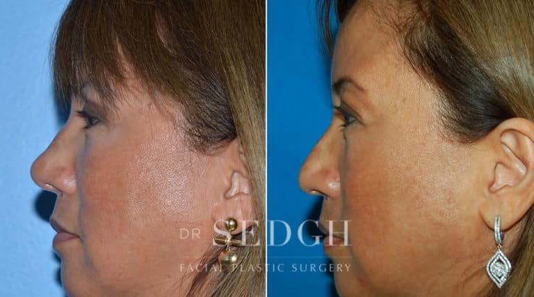 Female Rhinoplasty Before and After | Sedgh