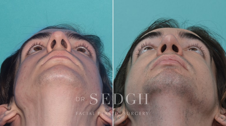 Male Rhinoplasty Before and After | Sedgh