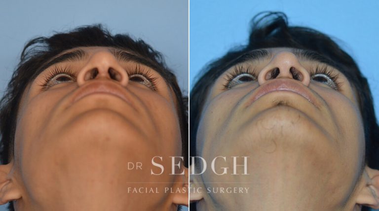 Male Rhinoplasty Before and After | Sedgh