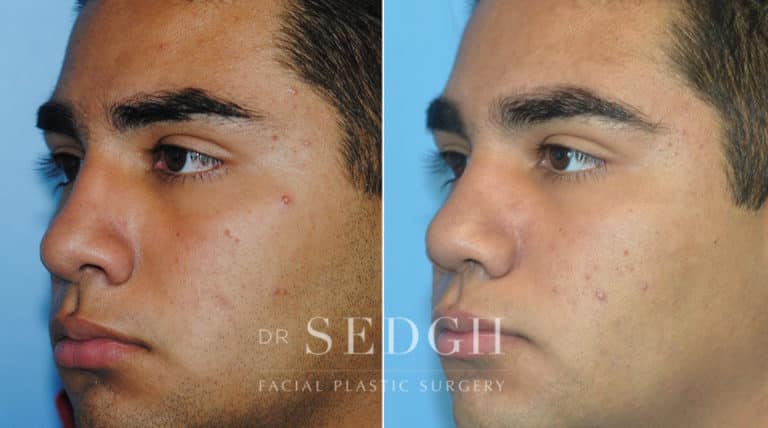 Latino Rhinoplasty Before and After | Sedgh