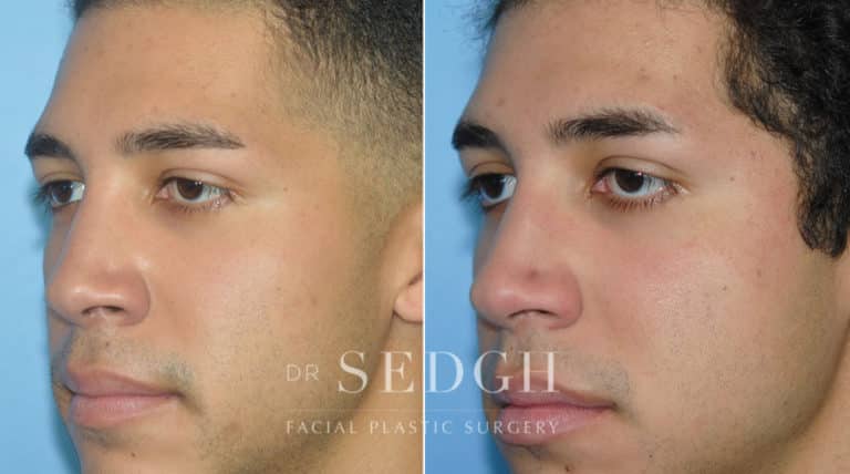 Rhinoplasty Before and After | Sedgh