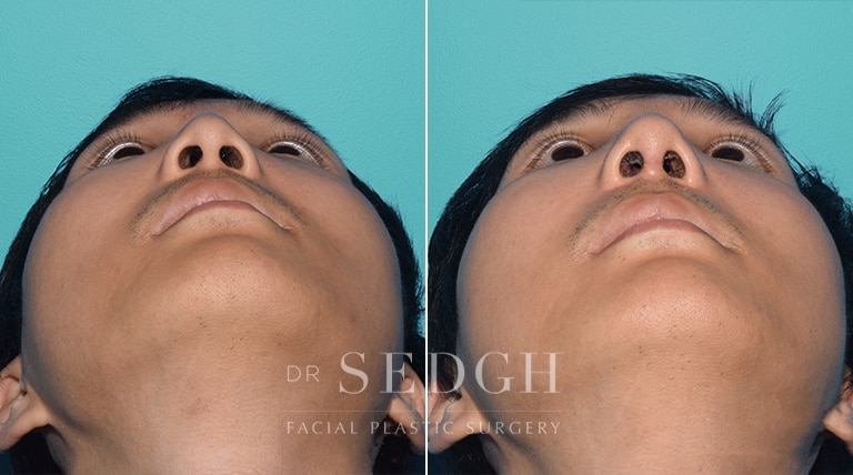 Asian Rhinoplasty Before and After | Sedgh