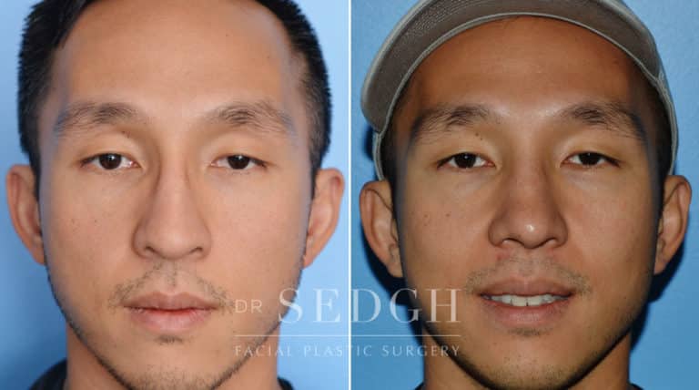 Asian Rhinoplasty Before and After | Sedgh