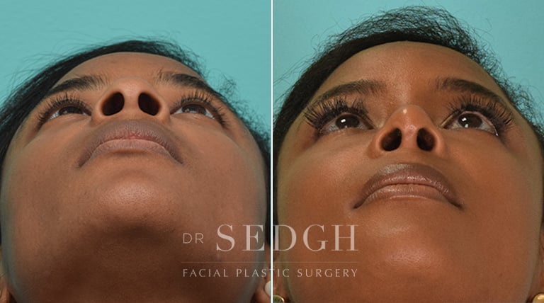 African American Rhinoplasty Before and After | Sedgh