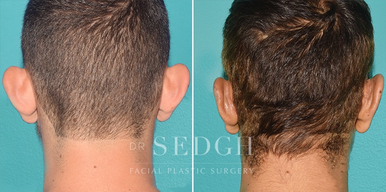 Ear Pinning Surgery Before and After | Sedgh