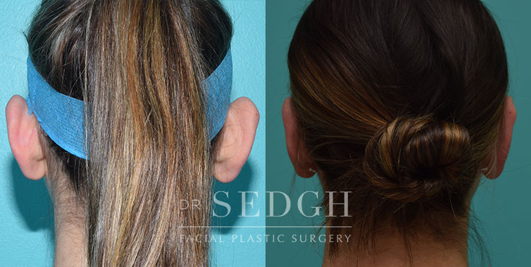 Ear Pinning Surgery Before and After | Sedgh