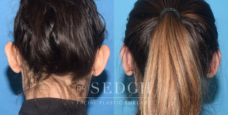 Ear Pinning Surgery Before and After | Sedgh