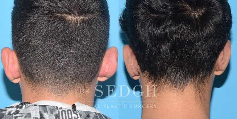 Ear Pinning Surgery Before and After | Sedgh