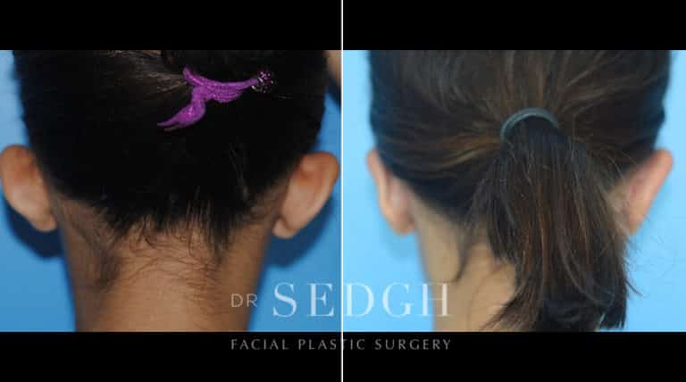 Ear Pinning Surgery Before and After | Sedgh