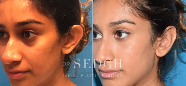 Ear Pinning Surgery Before and After | Sedgh