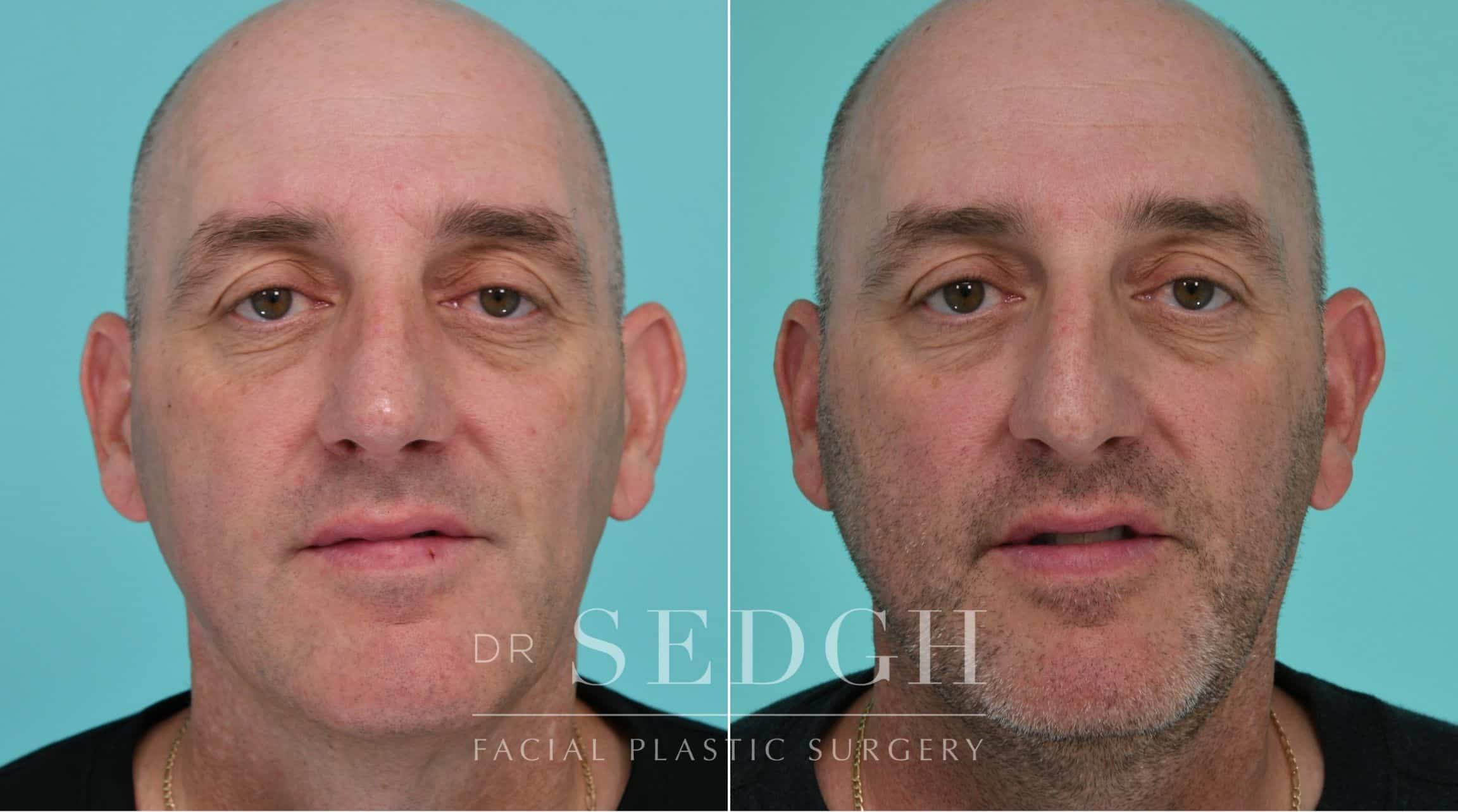 Patient before and after Rhinoplasty | Sedgh