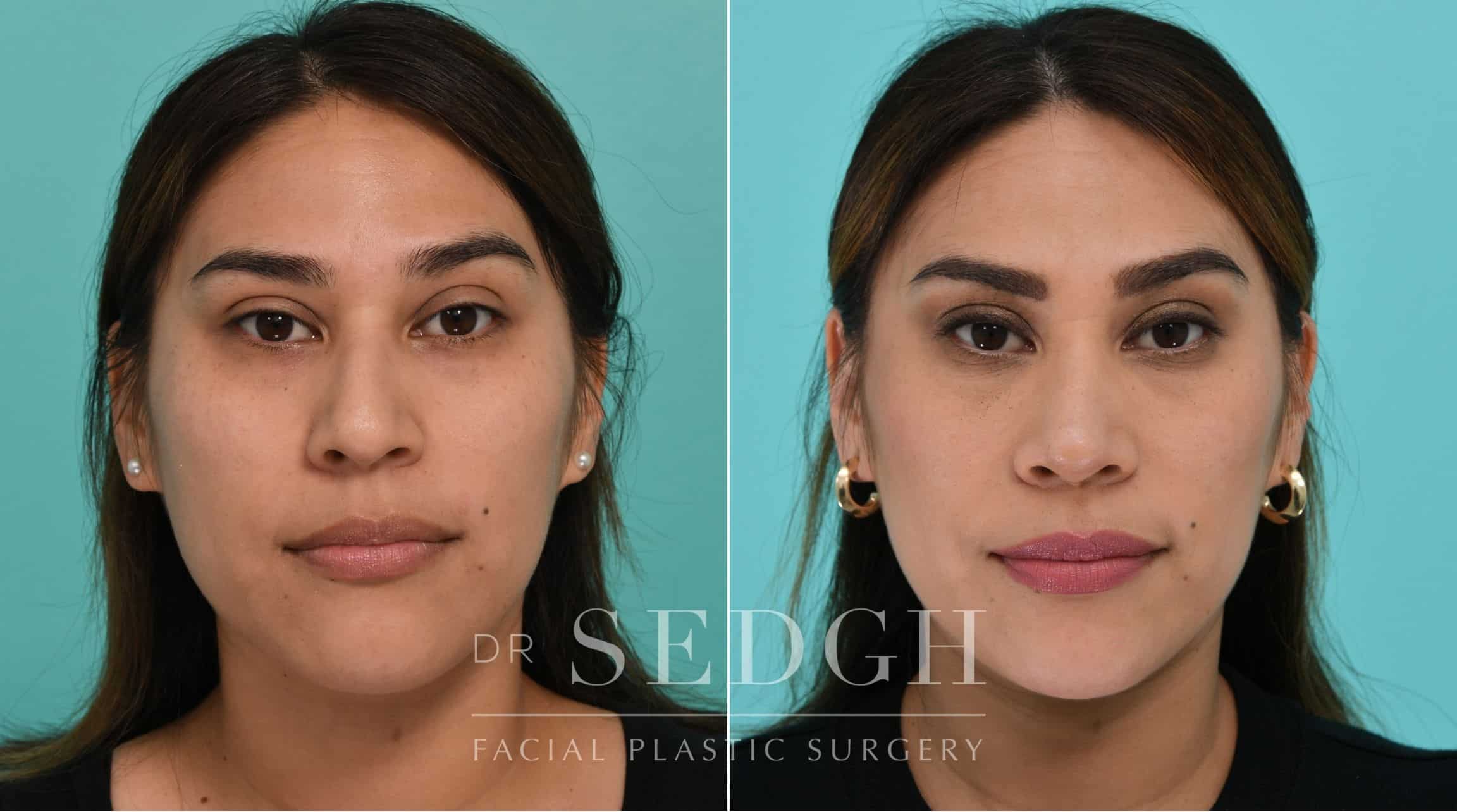 Patient before and after Rhinoplasty | Sedgh