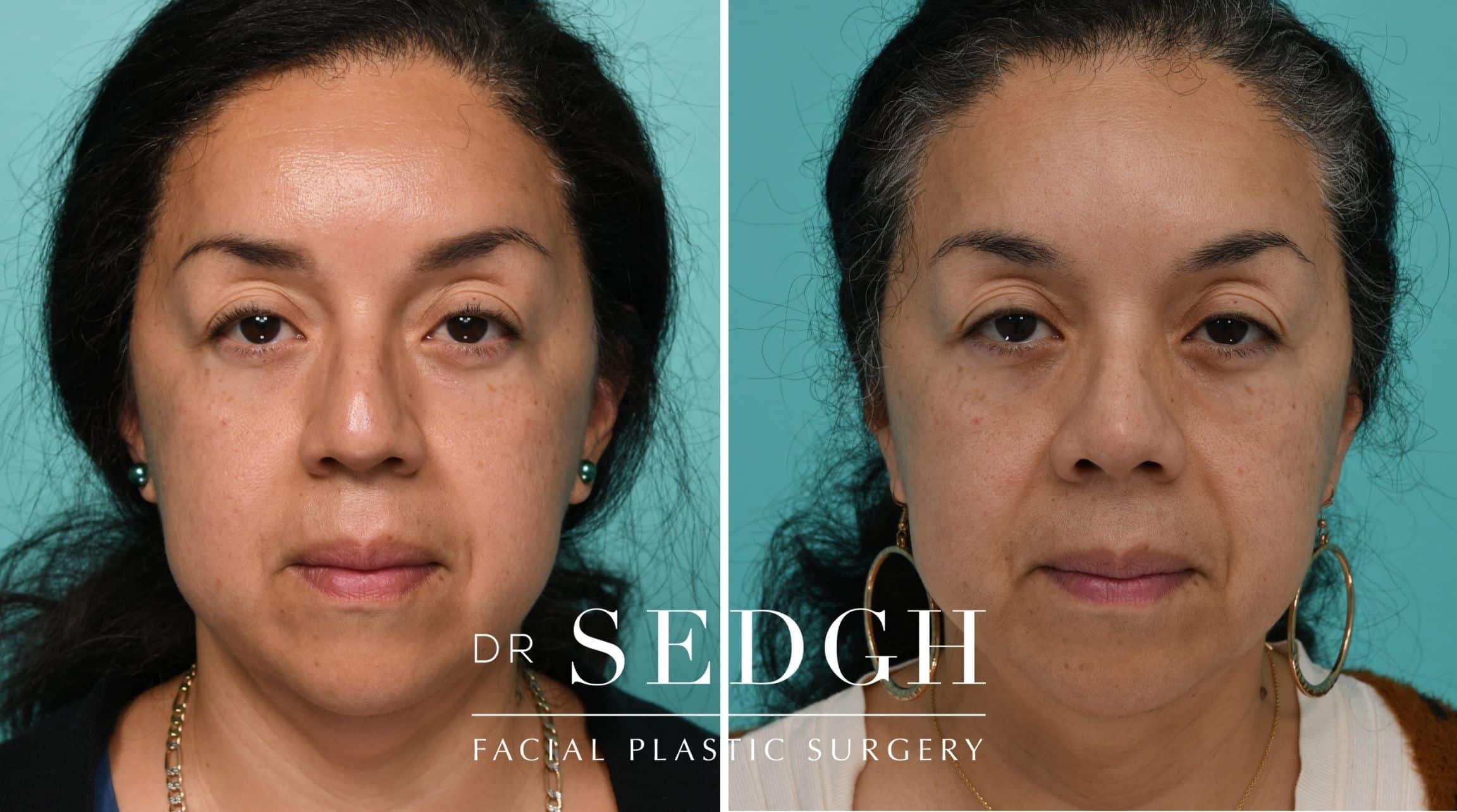 Patient before and after Revision Rhinoplasty | Sedgh