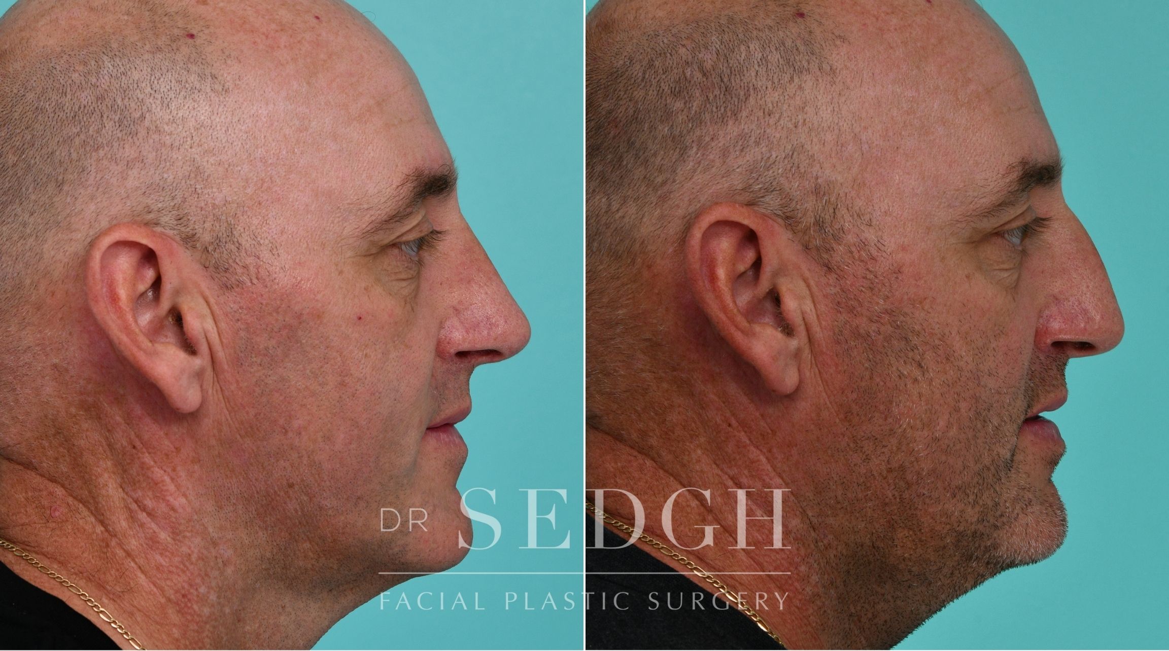 Patient before and after Rhinoplasty | Sedgh