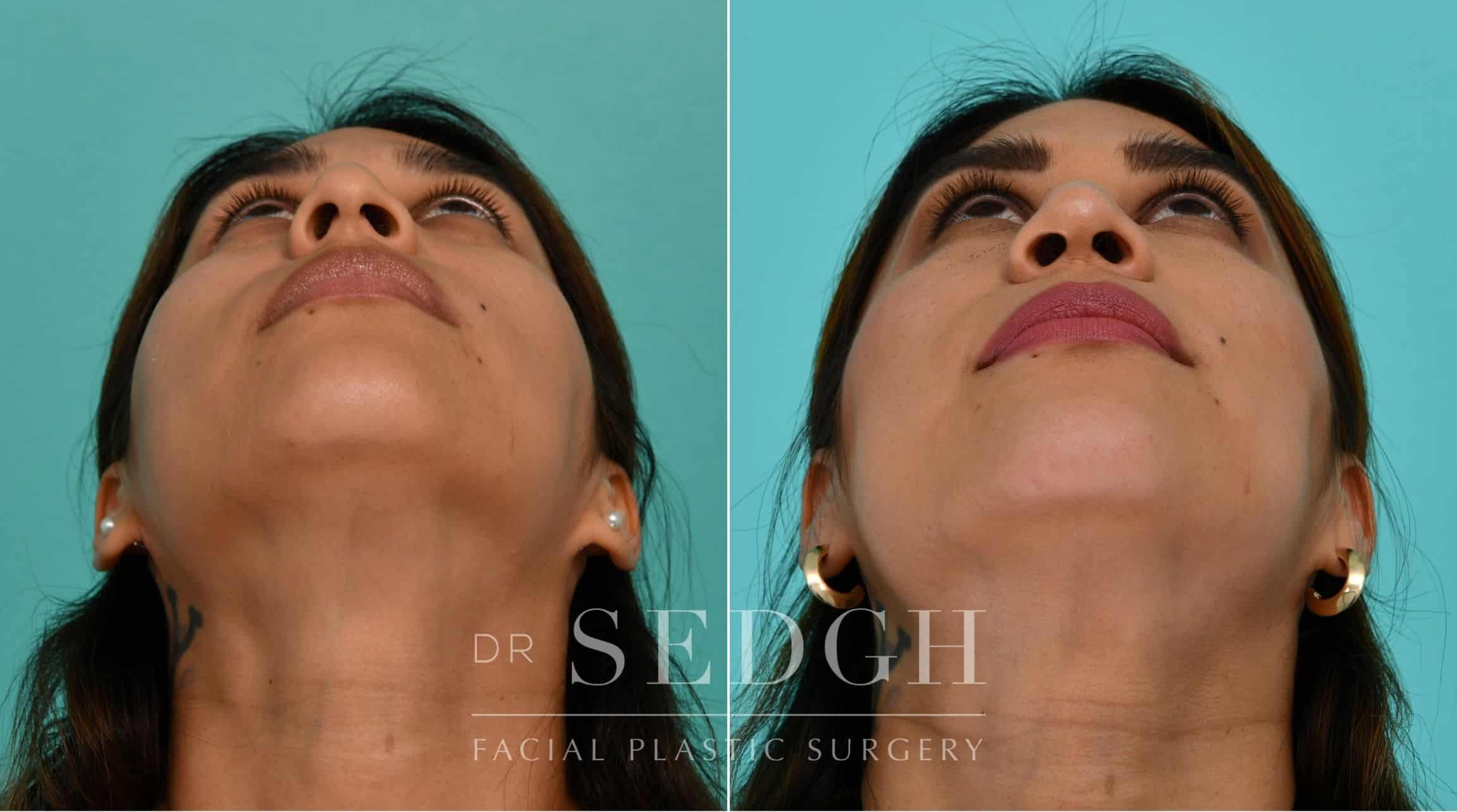 Patient before and after Rhinoplasty | Sedgh