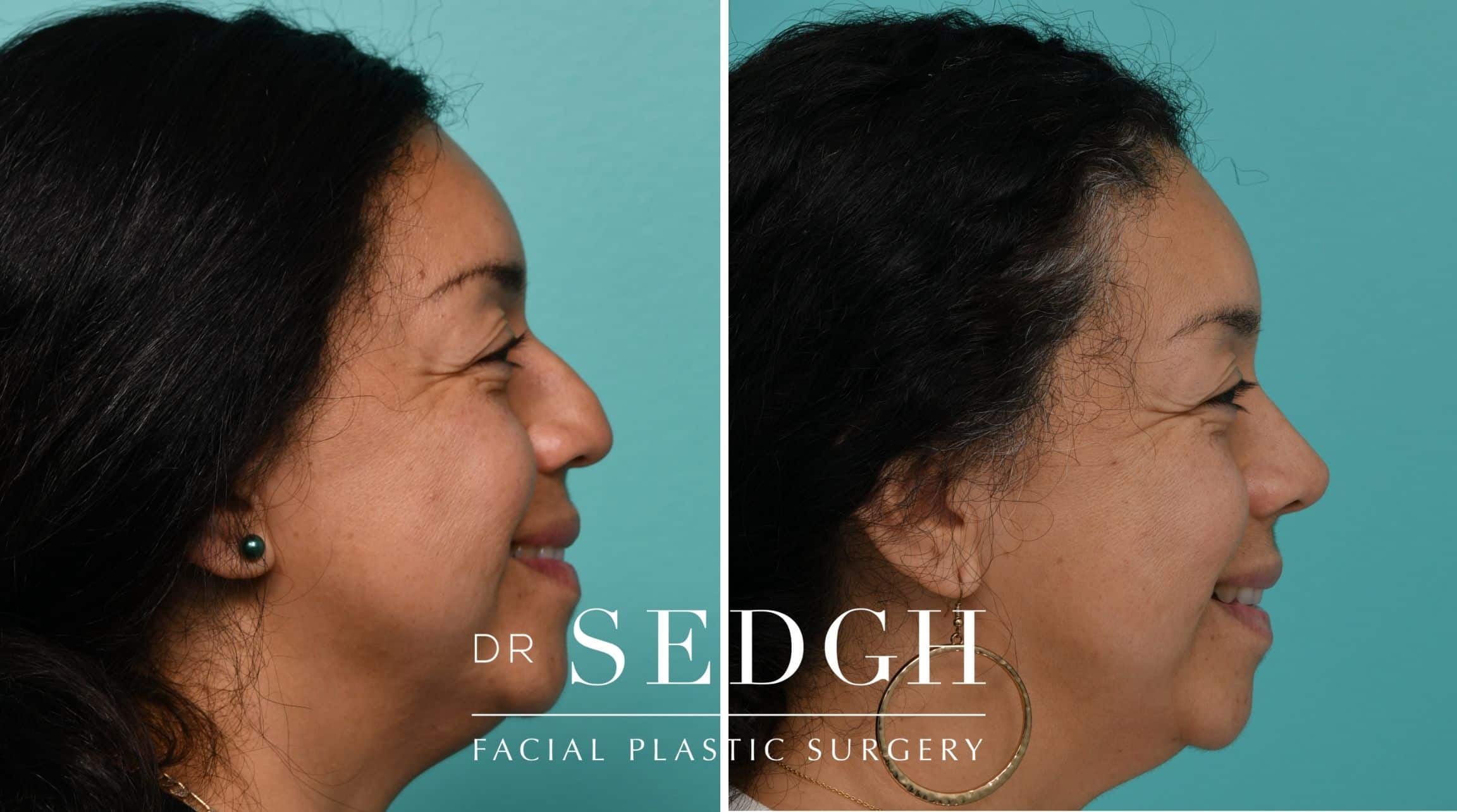 Patient before and after Revision Rhinoplasty | Sedgh