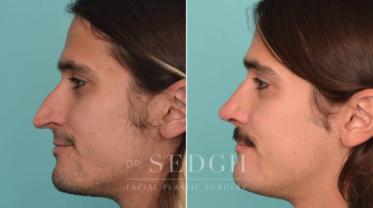 male patient before and after rhinoplasty procedure