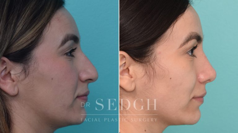 patient before and after rhinoplasty procedure | Sedgh