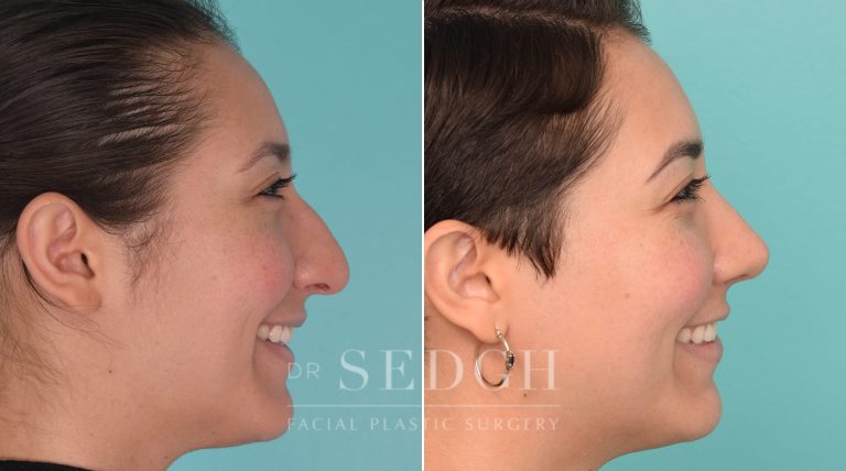 patient before and after rhinoplasty procedure | Sedgh