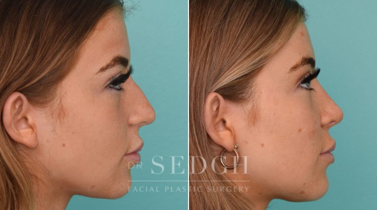 female patient before and after rhinoplasty procedure