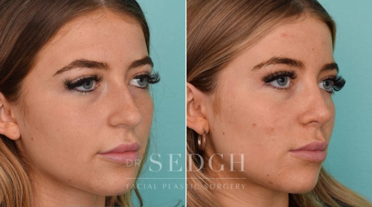 female patient before and after rhinoplasty procedure
