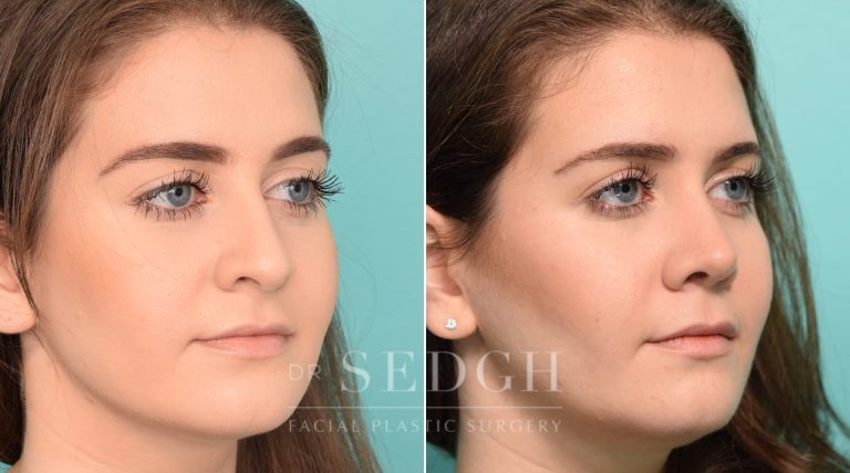 female patient before and after rhinoplasty procedure