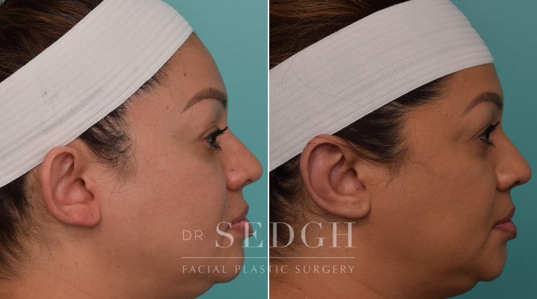 patient before and after otoplasty procedure