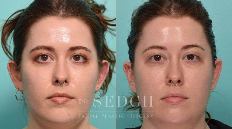 patient before and after otoplasty procedure