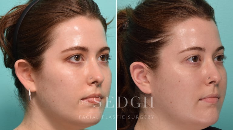 patient before and after otoplasty procedure