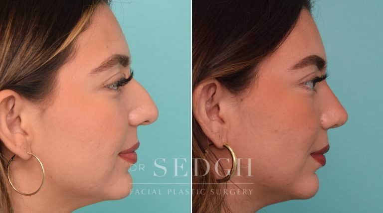 patient before and after rhinoplasty procedure | Sedgh