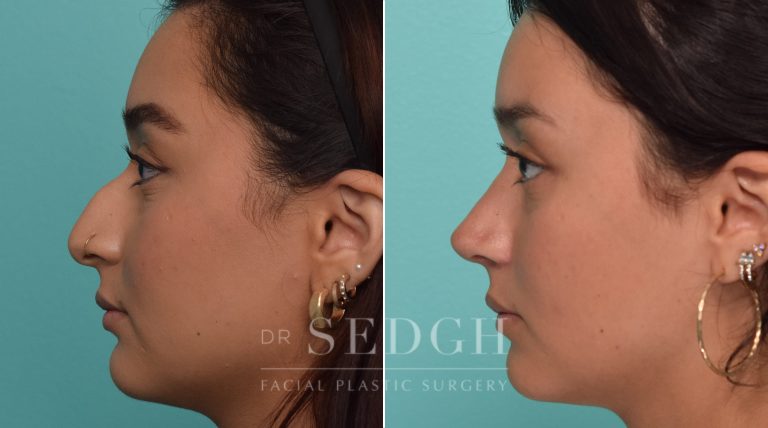Female Patient Before and After Rhinoplasty | Sedgh