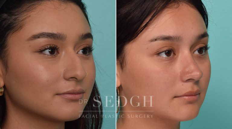 Female Patient Before and After Rhinoplasty | Sedgh