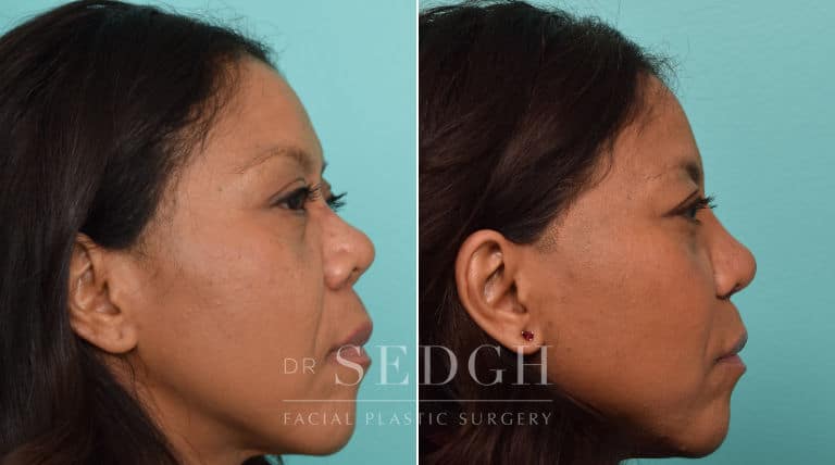 female patient before and after rhinoplasty