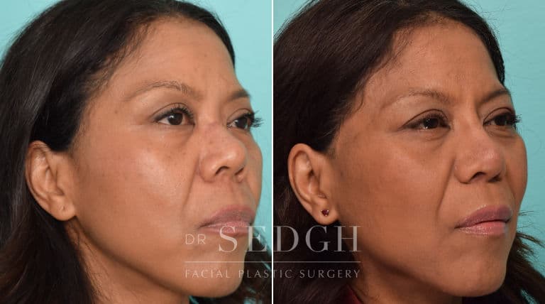 female patient before and after rhinoplasty