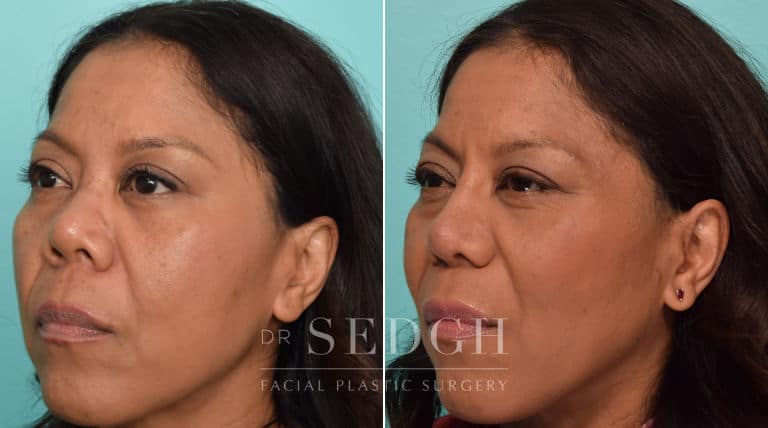 female patient before and after rhinoplasty