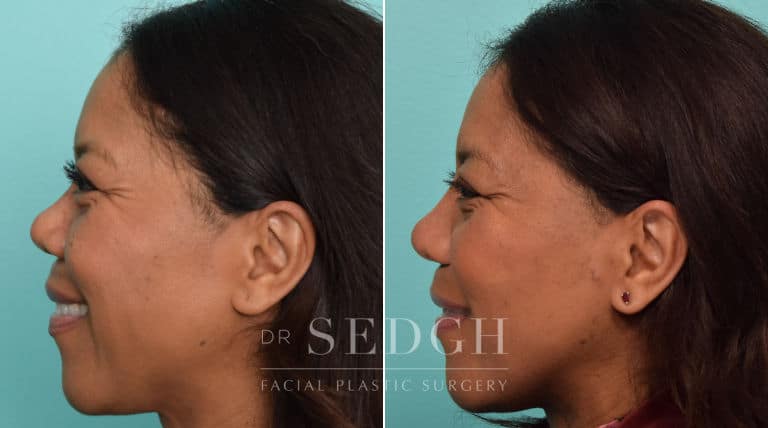 female patient before and after rhinoplasty