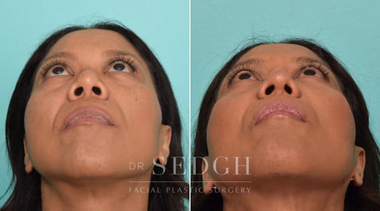 female patient before and after rhinoplasty