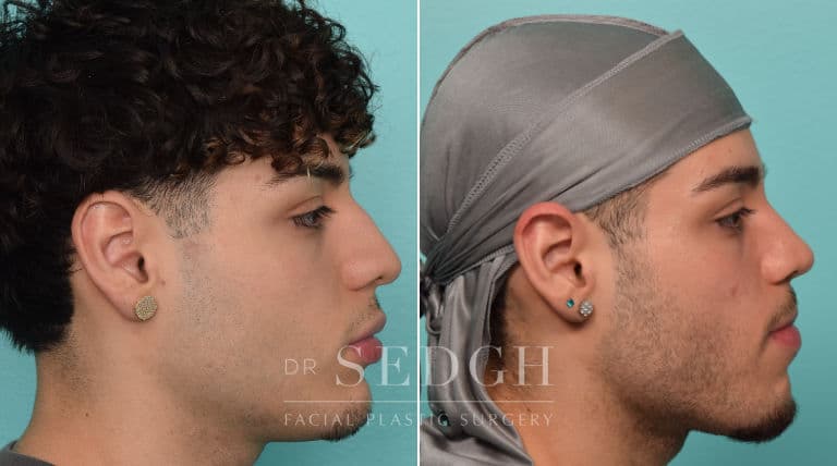 male patient before and after rhinoplasty