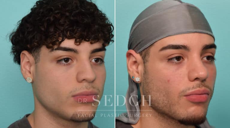 male patient before and after rhinoplasty