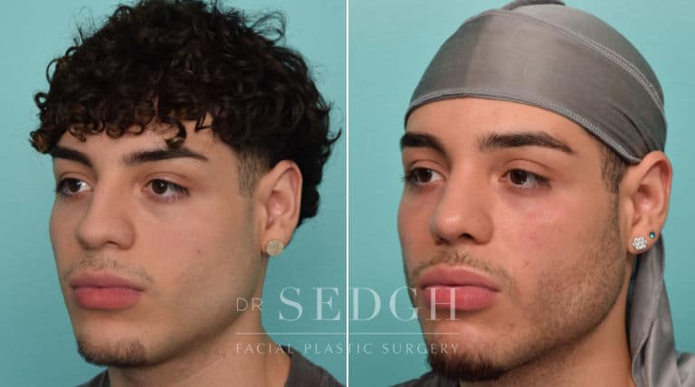 male patient before and after rhinoplasty