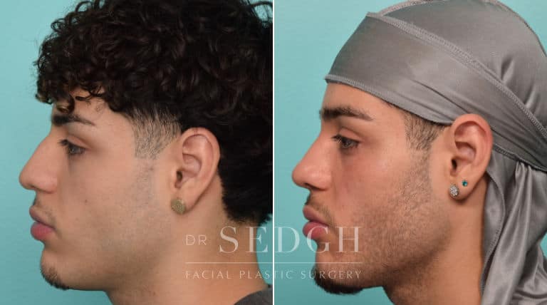 male patient before and after rhinoplasty