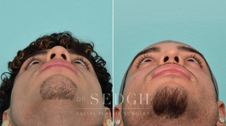 male patient before and after rhinoplasty