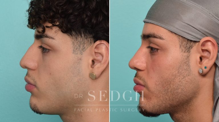 Male Patient Before and After Rhinoplasty | Sedgh