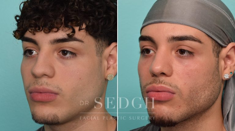Male Patient Before and After Rhinoplasty | Sedgh