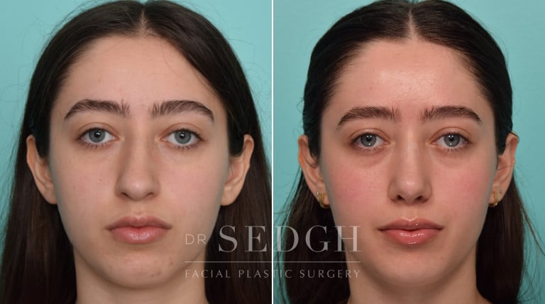 female patient before and after rhinoplasty