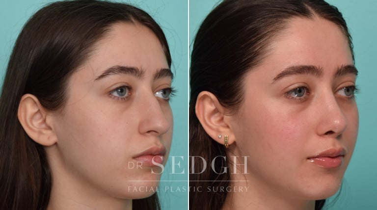 female patient before and after rhinoplasty