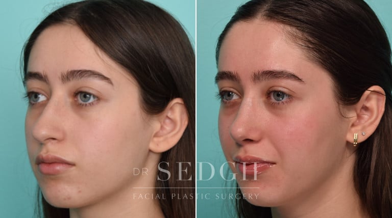 female patient before and after rhinoplasty