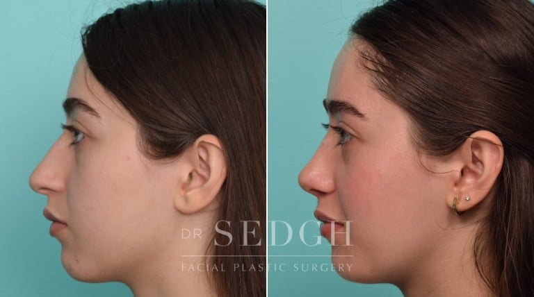 female patient before and after rhinoplasty