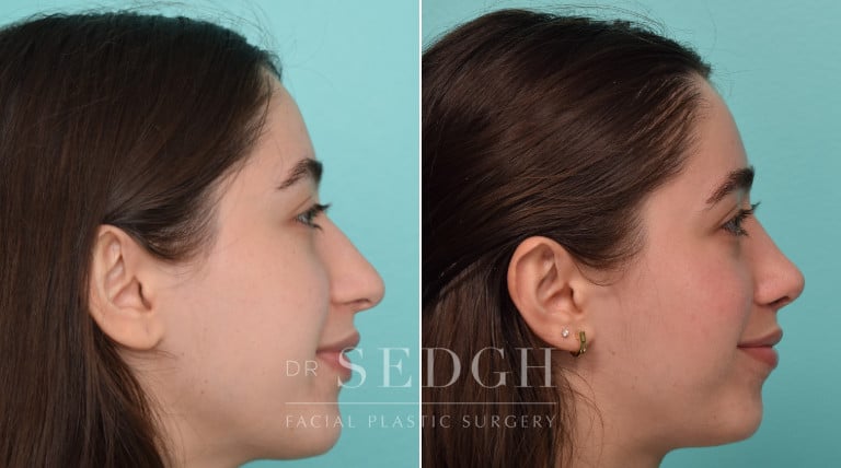 female patient before and after rhinoplasty