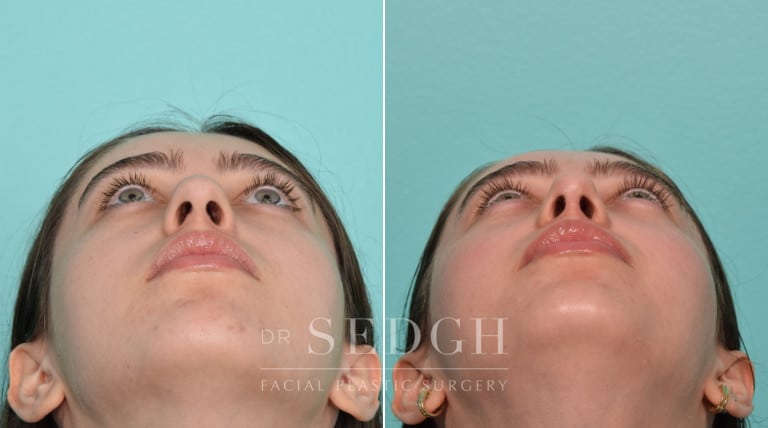 female patient before and after rhinoplasty